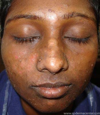 Impetigo-After