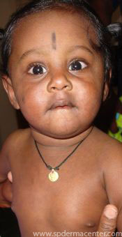 Impetigo After