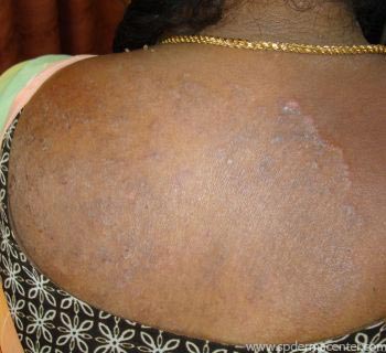 Tinea-Before