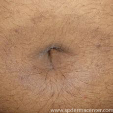 Psoriasis-After