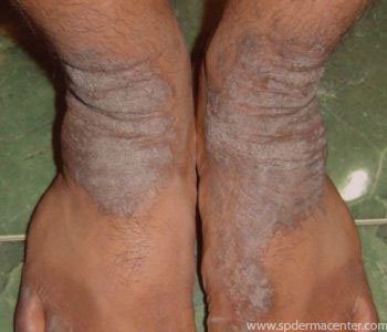 Lichen Simplex-Before