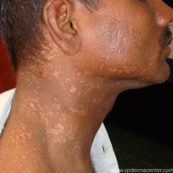 Herpes-Zoster-After