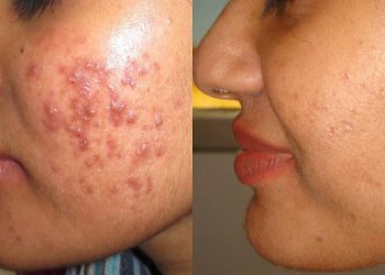 Acne(Pimples) cause and IPL treatment