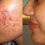 Acne (Pimples) Treatment & Causes