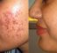 Acne(Pimples) cause and IPL treatment