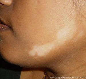 Vitiligo Chin treated by Targeted Excimer Phototherapy