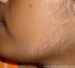 Vitiligo Chin treated by Targeted Excimer Phototherapy