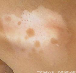 Vitiligo neck