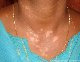 Vitiligo Neck treated by Targeted Excimer Phototherapy