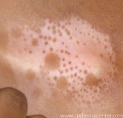 Vitiligo neck