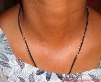 Vitiligo Neck treated by Targeted Excimer Phototherapy