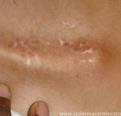 Vitiligo neck