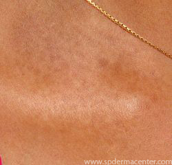 Vitiligo neck