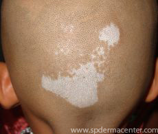 Vitiligo Scalp treated by Targeted Excimer Phototherapy