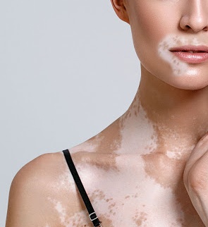 Vitiligo treated by Targeted Excimer Phototherapy