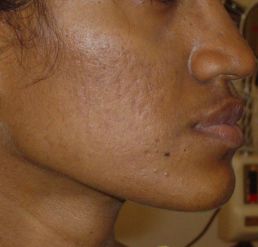 Acne Grade three Acne Treatment: Before & After Gallery