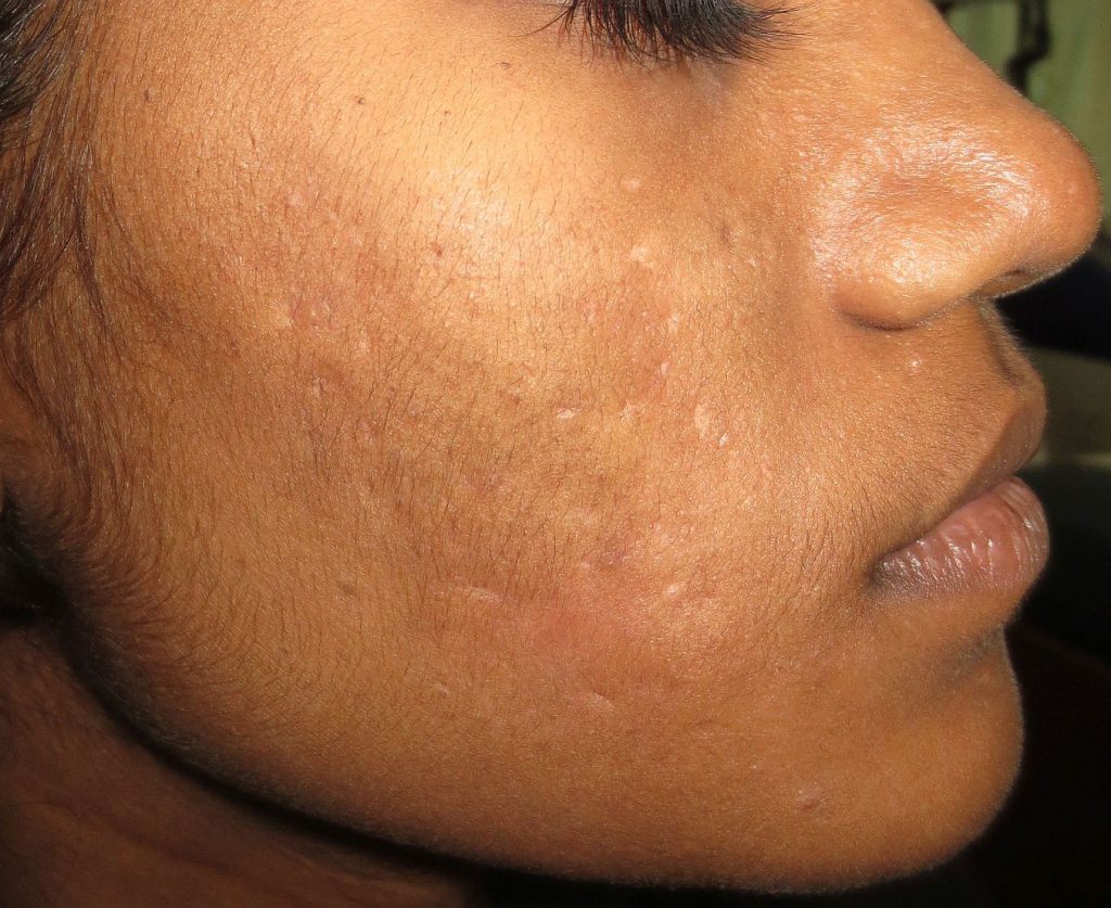 Acne Cystic type
