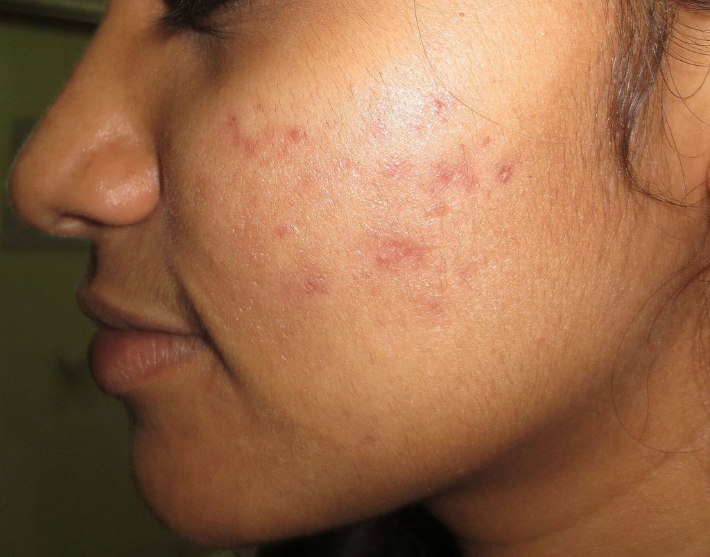 Acne Grade three IPL