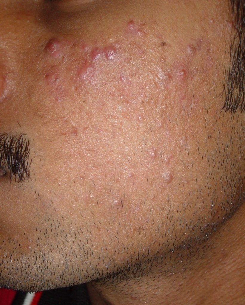 Acne Grade two