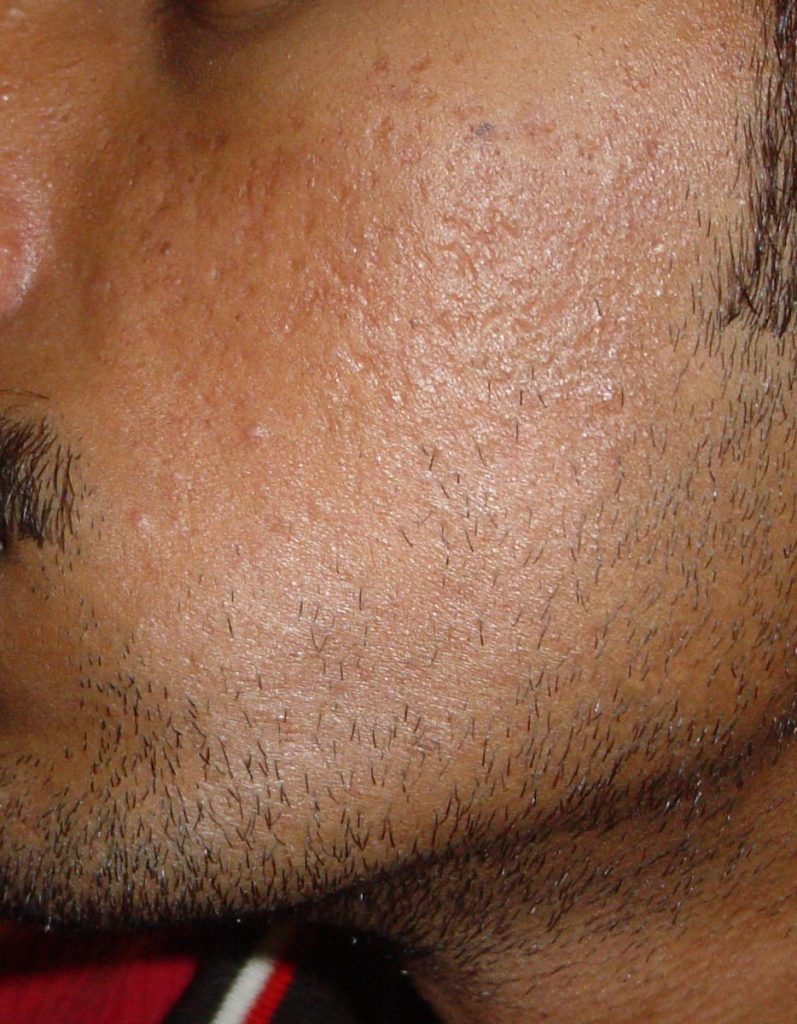 Acne Grade two