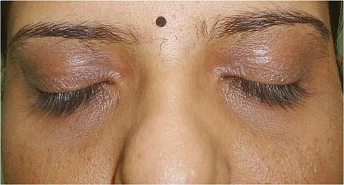 Dark Circle Pigmentation Treatment