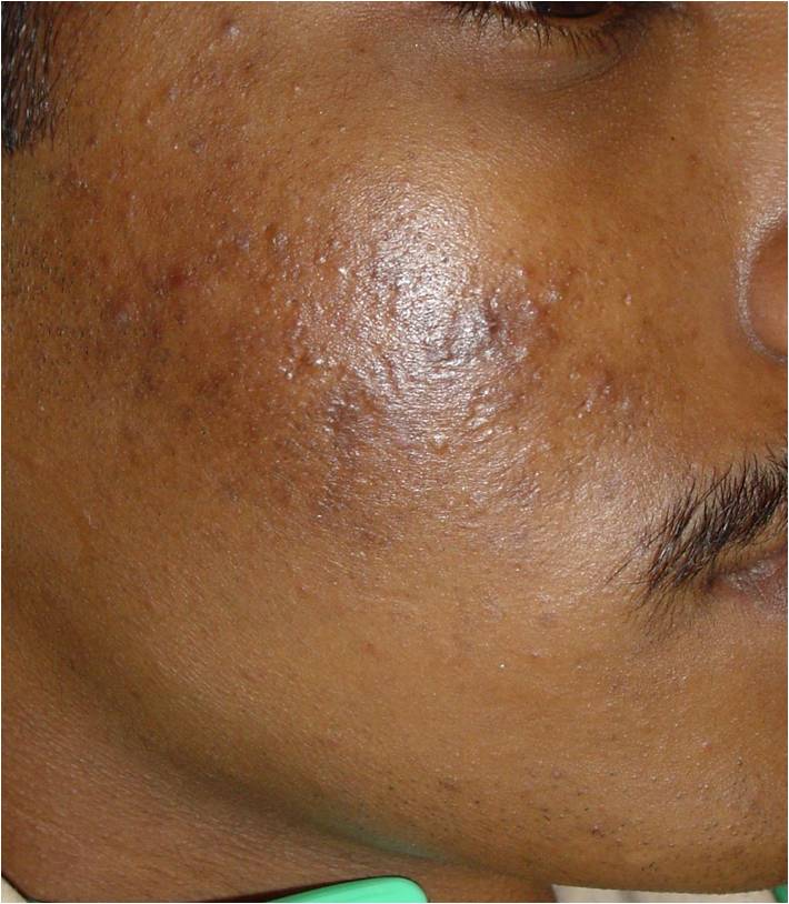 Dark Pigmentation Before