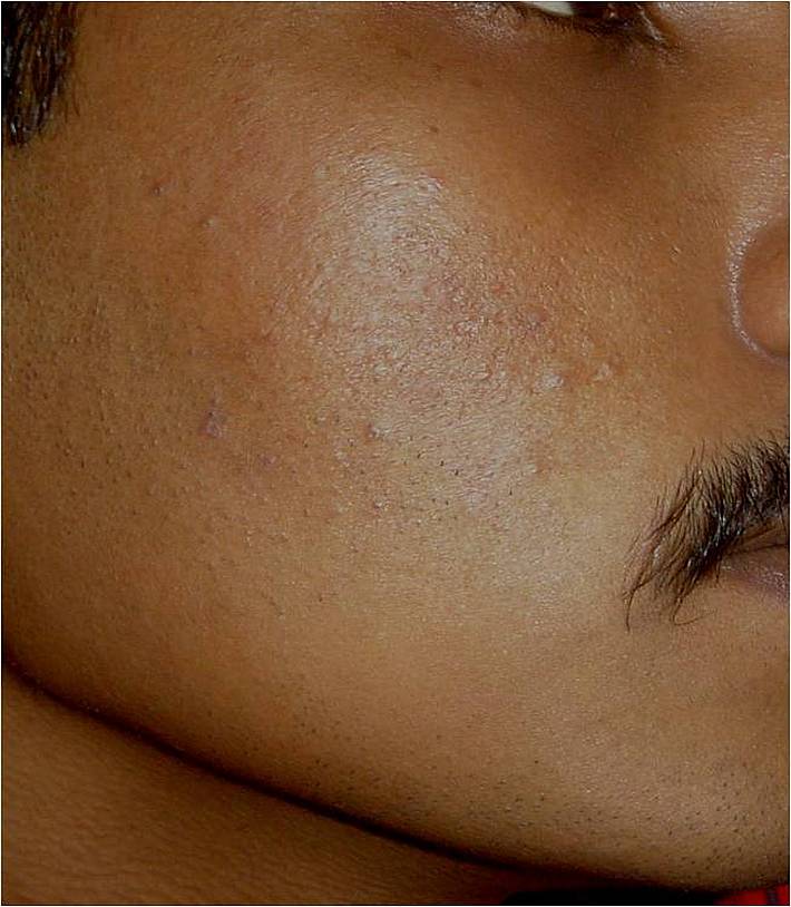 Dark Pigmentation After