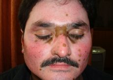 Vitiligo / Leucoderma Treatment