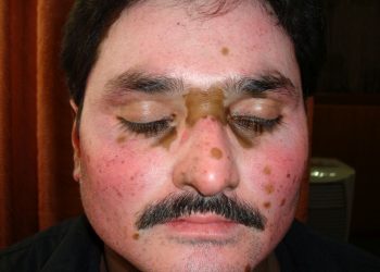 Vitiligo / Leucoderma Treatment